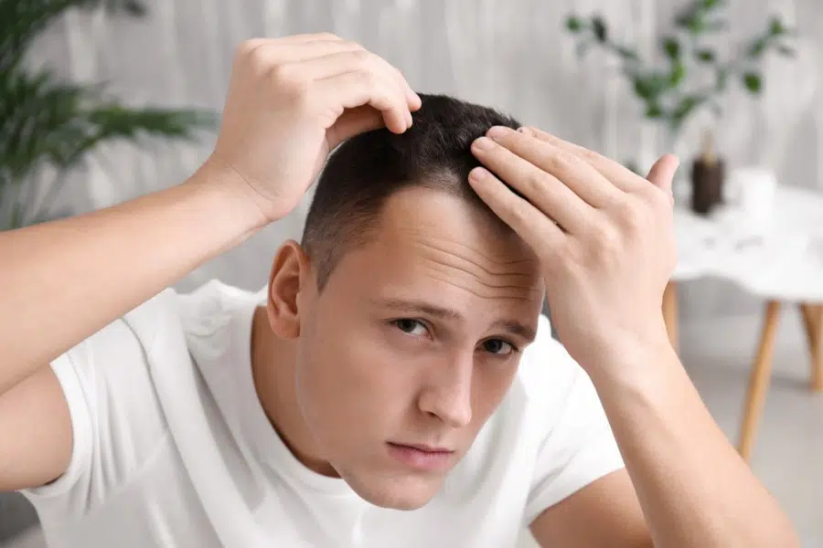 calvitie-homme-jeune